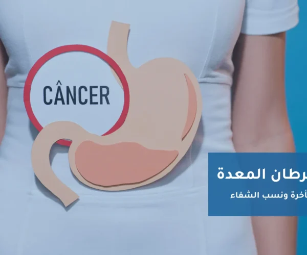 أعراض سرطان المعدة (المبكرة والمتأخرة)
