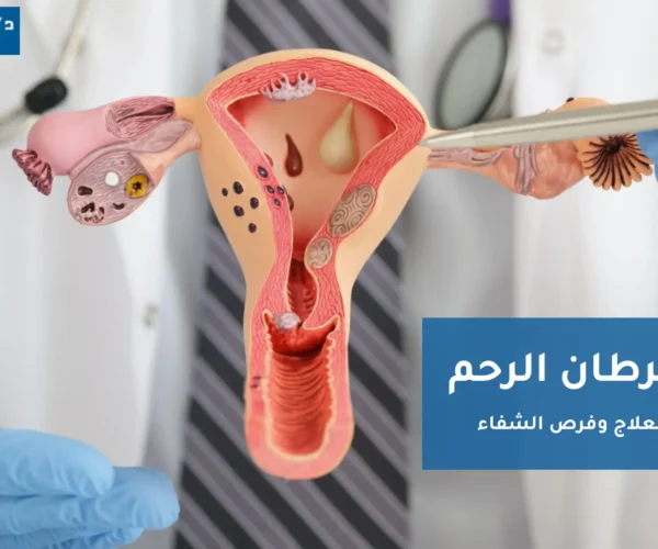 علاج سرطان الرحم