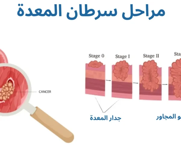 مراحل سرطان المعدة