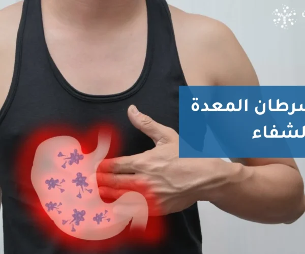 مراحل سرطان المعدة ونسب الشفاء