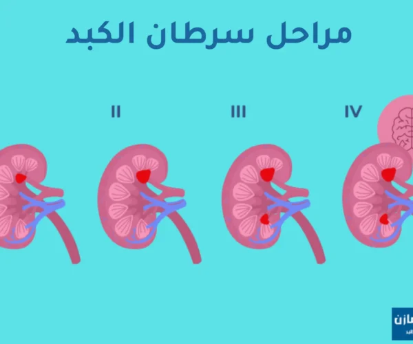 مراحل سرطان الكبد بالصور