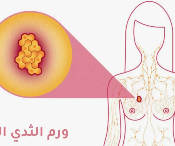 اعراض ورم الثدي المبكر (خبيث في بدايته) بالصور