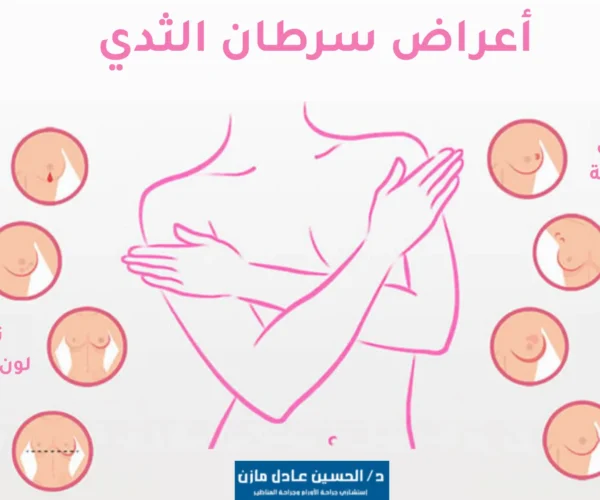 أعراض ورم الثدي بالصور عند النساء 
