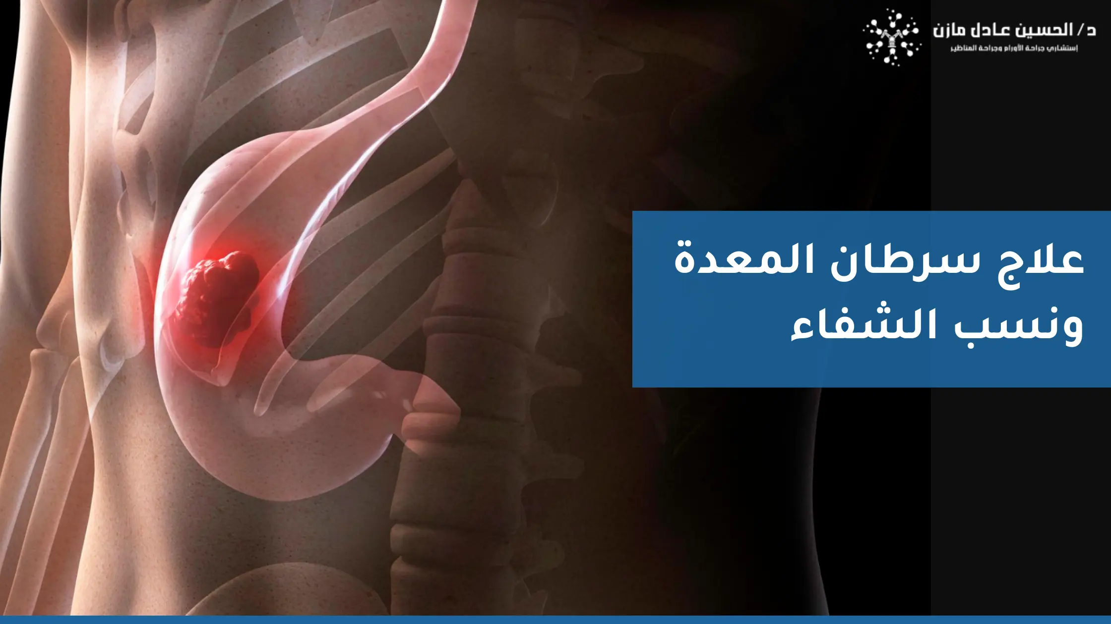 علاج سرطان المعدة