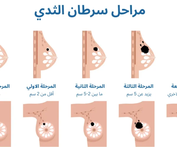 مراحل سرطان الثدي بالصور - الدكتور الحسين مازن